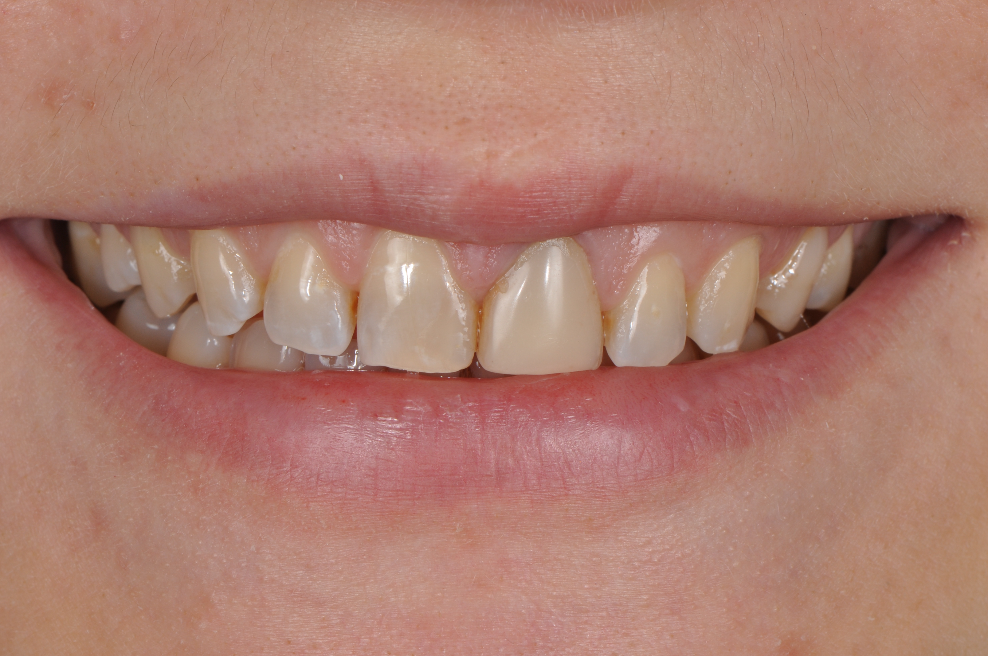 Художественная реставрация зуба